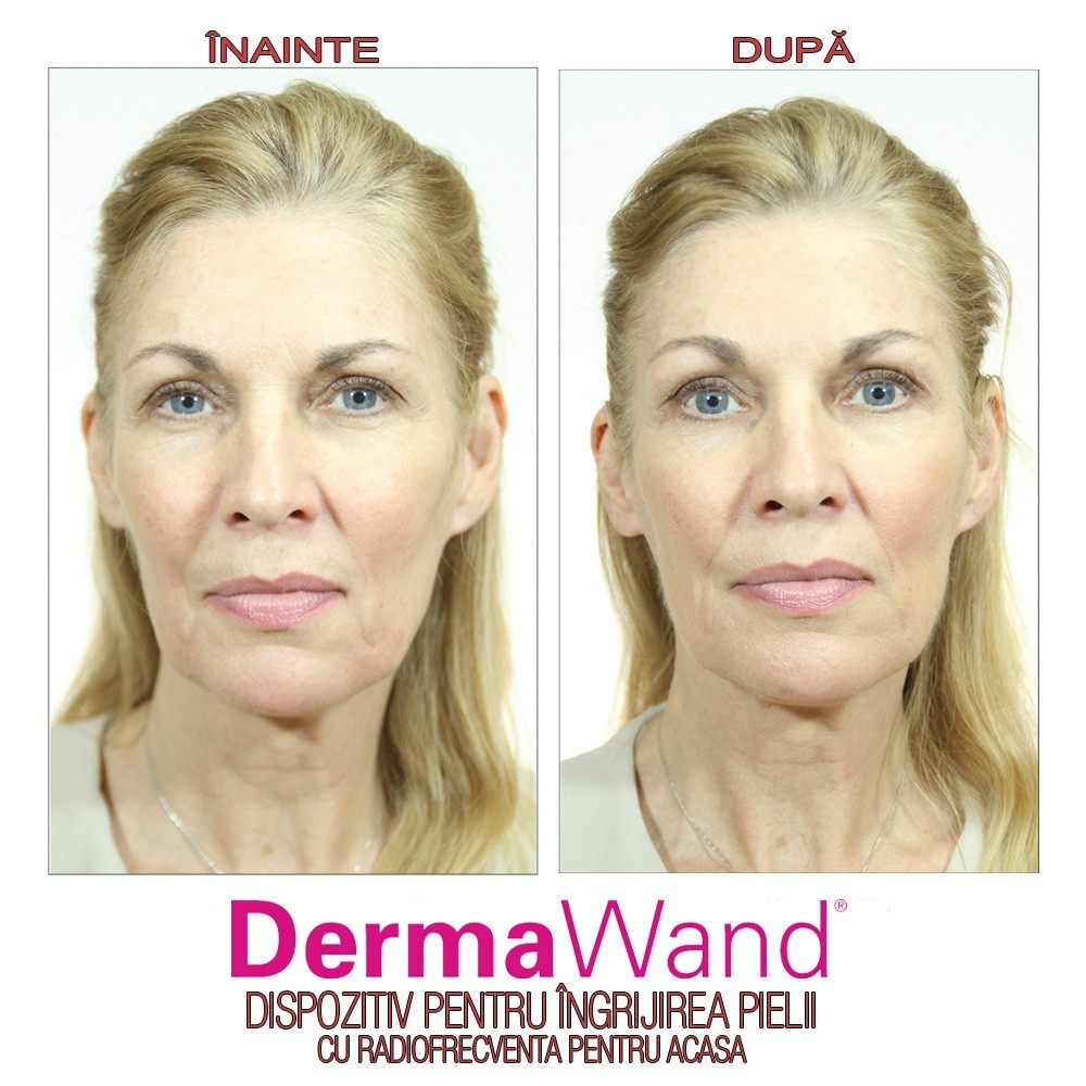 DermaWand - dispozitiv pentru ingrijirea pielii | Produs Original de la Telestar