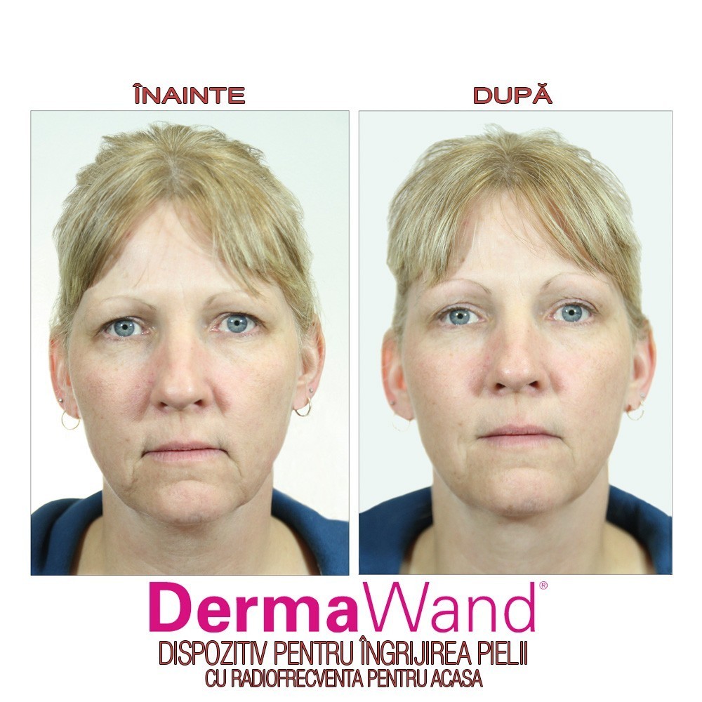 DermaWand - dispozitiv pentru ingrijirea pielii | Produs Original de la Telestar