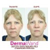 DermaWand - dispozitiv pentru ingrijirea pielii | Produs Original de la Telestar