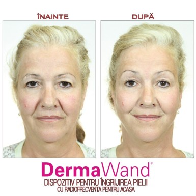 DermaWand - dispozitiv pentru ingrijirea pielii | Produs Original de la Telestar DermaWand - dispozitiv pentru ingrijirea pielii | Produs Original de la Telestar