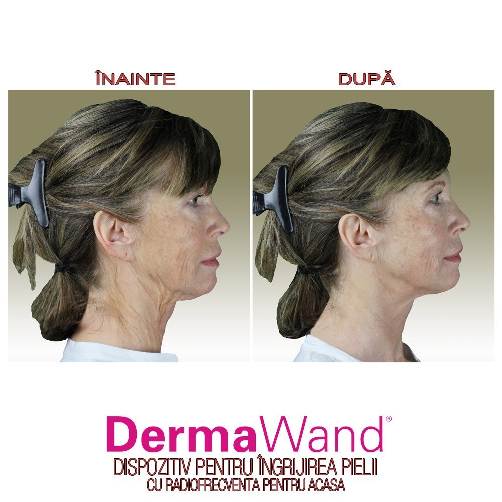 DermaWand - dispozitiv pentru ingrijirea pielii | Produs Original de la Telestar