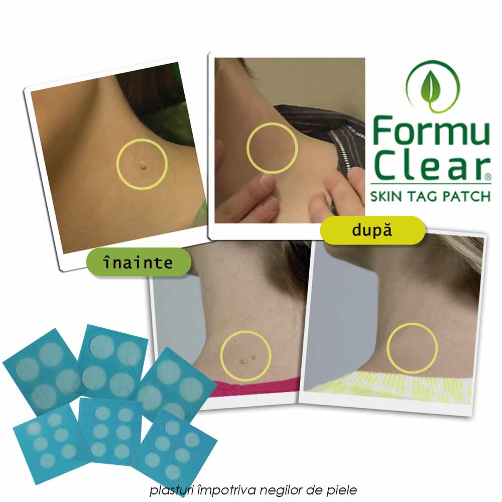 FormuClear Skin Tag Patch + SaniSkin Telestar la Pret Redus!