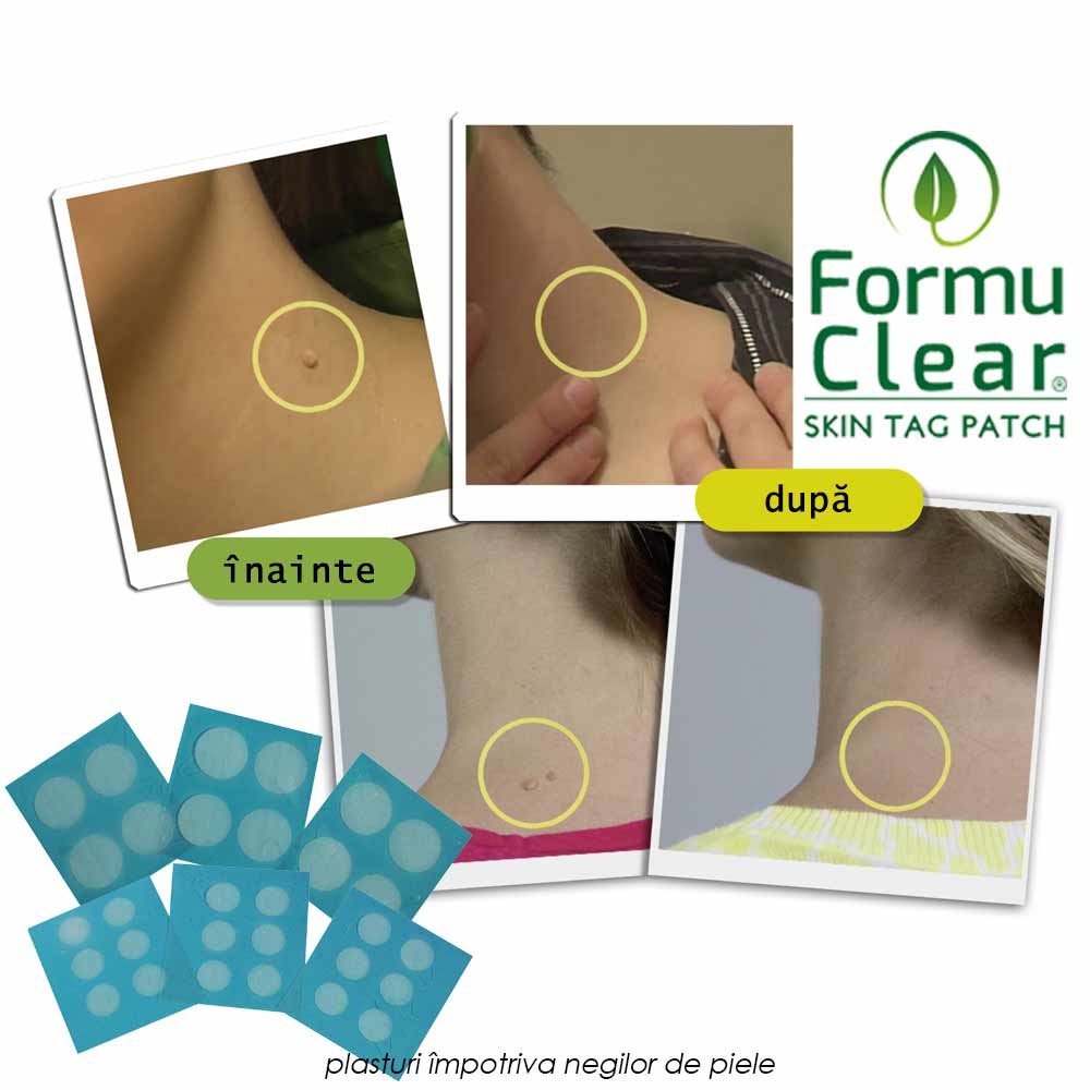 Pachet PROMO: FormuClear Skin Tag Patch + SaniSkin