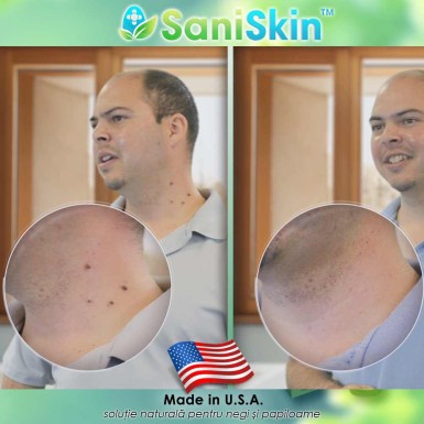 Pachet PROMO: FormuClear Skin Tag Patch + SaniSkin Pachet PROMO: FormuClear Skin Tag Patch + SaniSkin