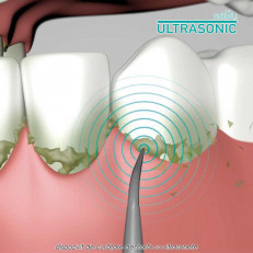 Starlyf Ultrasonic - dispozitiv de curatare dentara cu ultrasunete