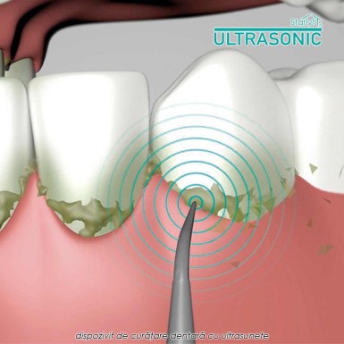 Starlyf Ultrasonic - dispozitiv de curatare dentara cu ultrasunete Starlyf Ultrasonic - dispozitiv de curatare dentara cu ultrasunete