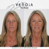 Venoia Syn-Ake Eye Serum - ser pentru ochi cu venin sintetic de sarpe Venoia Syn-Ake Eye Serum - ser pentru ochi cu venin sintetic de sarpe