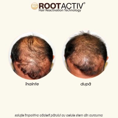 Rootactiv - soluție împotriva căderii părului cu celule stem din curcuma Rootactiv - soluție împotriva căderii părului cu celule stem din curcuma
