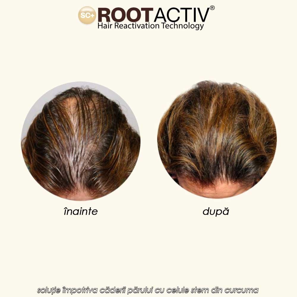 Rootactiv - soluție împotriva căderii părului cu celule stem din curcuma