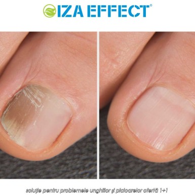 IZA Effect - soluție pentru problemele unghiilor și picioarelor ofertă 1+1 IZA Effect - soluție pentru problemele unghiilor și picioarelor ofertă 1+1