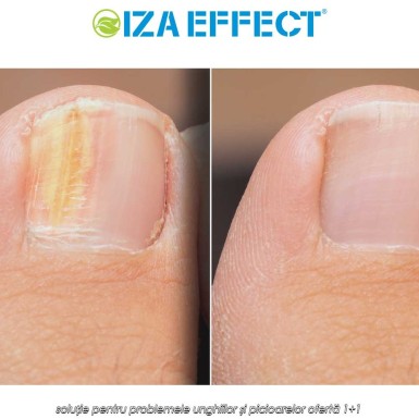 IZA Effect - soluție pentru problemele unghiilor și picioarelor ofertă 1+1 IZA Effect - soluție pentru problemele unghiilor și picioarelor ofertă 1+1